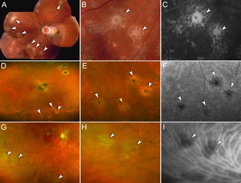 Representative Cases Of Peripheral Chrysanthemum Lesions On Multimodal