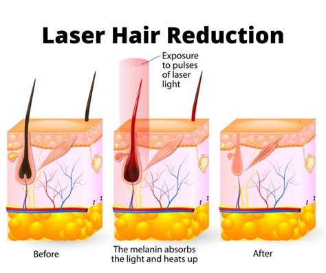 Laser Hair Reduction Southern Vascular Specialist