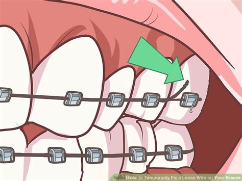 3 Ways to Temporarily Fix a Loose Wire on Your Braces - wikiHow