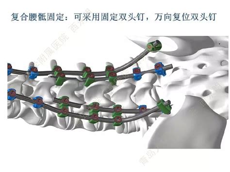 皮质骨螺钉技术及临床应用 好医术早读文章 好医术 赋能医生守护生命