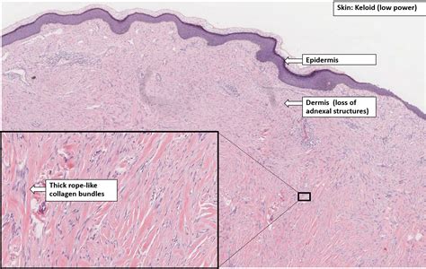 Keloid Histology