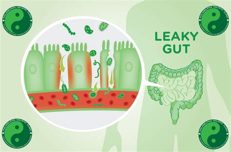 Treatment for Leaky Gut - Philadelphia Homeopathic Clinic - Dr. Tsan & Co