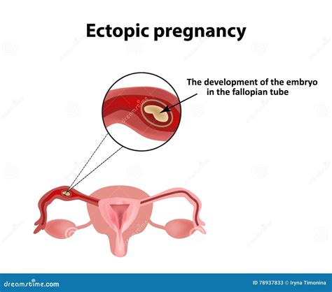 Embarazo Ectópico El Embrión En El Tubo De Falopio Infografía Ejemplo