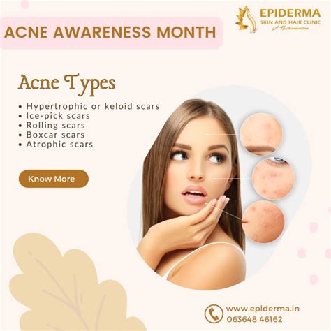 Ppt Acne Types Best Skin Clinic In Jayanagar Bangalore Epiderma Skin Clinic Powerpoint