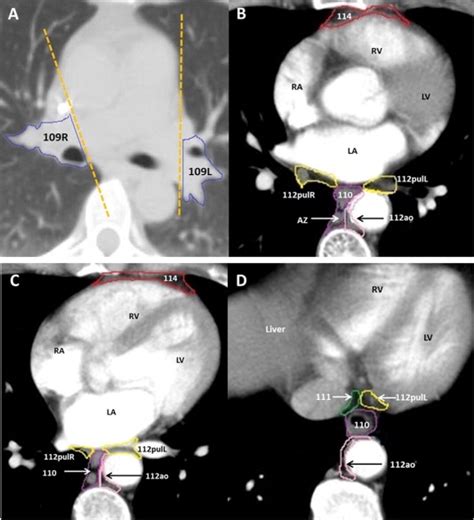 Atlas Of The Thoracic Lymph Nodal Delineation And Recommendations For