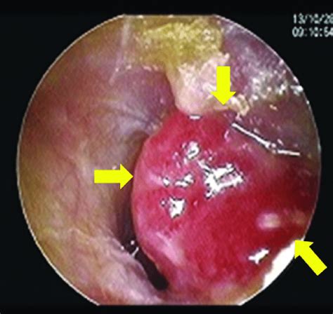 Pre-operative right ear canal appearance. A tumor was observed in the ...