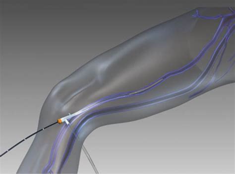 Closurefast Radiofrequency Closure Procedure