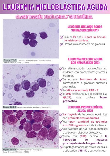 Leucemia Mieloblástica Aguda MedCast uDocz