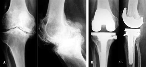 A Years Man With Preoperative O Varus And O Fixed Flexion