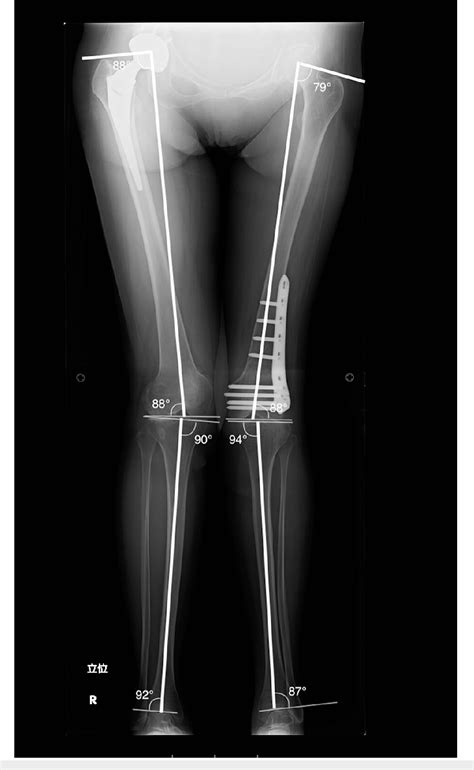 Pdf Combined Femoral Osteotomy And Contralateral Hip Arthroplasty To