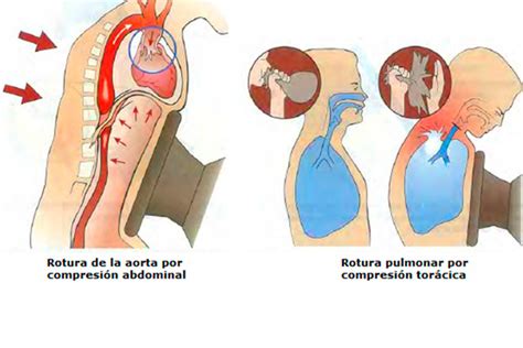 Trauma de Tórax Sociedad Argentina de Medicina de Urgencias y Emergencias