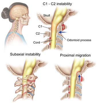 Rheumatoid Arthritis of the Cervical Spine -Redlands, Loma Linda ...