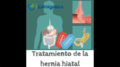 Tratamiento De La Hernia Hiatal Youtube