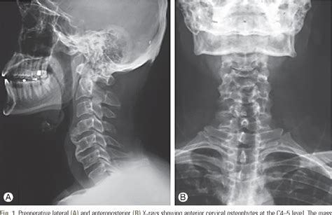 Cervical Osteophytes