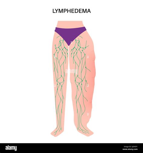 Swollen Lymph Nodes In Inner Thigh