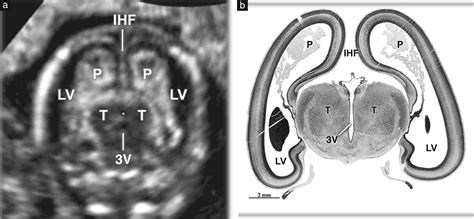 Firsttrimester Fetal Neurosonography Technique And Diagnostic