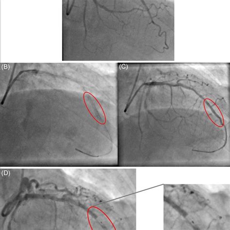 (A) Removal of the distal LAD stent. (B) A 26‐gauge needle inserted ...