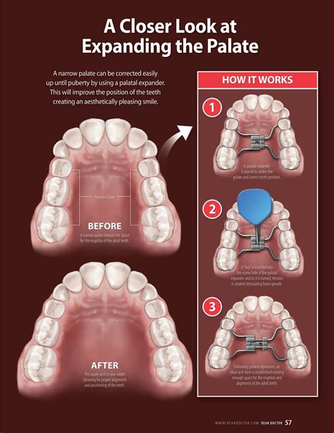 Expansi N Maxilar Consulta De Ortodoncia Y Est Tica Dental Health La