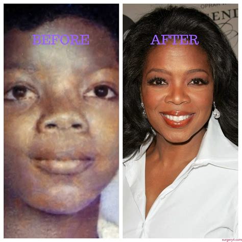 Oprah Winfrey Plastic Surgery Photos Before And After Surgery4