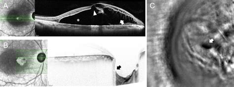 Case #4. (A) SD-OCT scan showing macular retinoschisis (arrow ...