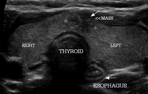 Toxic Multinodular Goiter Echocardiography Or Ultrasound Wikidoc ...