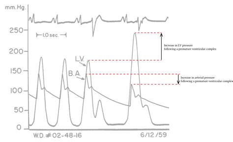 Left Ventricular Outflow Tract Obstruction Deranged Physiology