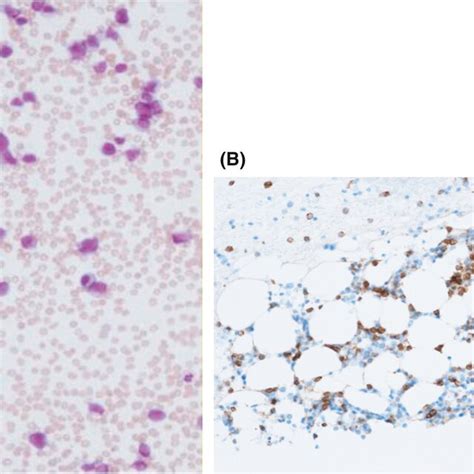 The Bone Marrow Smear Peroxidase Positive Blasts Were Counted At