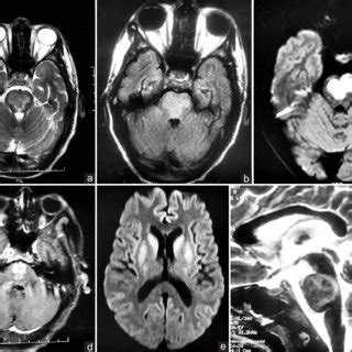 MRI Brain Reveals Focal Altered Signal Intensity Lesions Hyper On T2 A