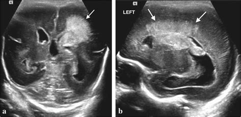 Parenchymal Hemorrhagic Venous Infarction In A 26 Week Gestational Age