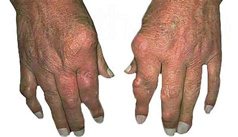 Picture Of Gout Affected Hands