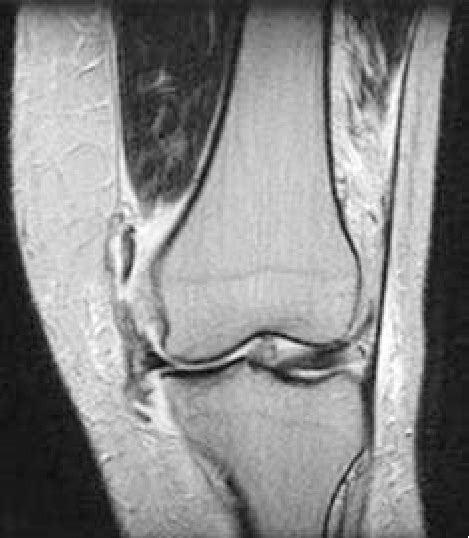 Magnetic Resonance Image Of The Knee Showing Multiple Injuries Of The