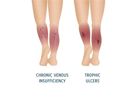 Chronic Venous Insufficiency Cvi Treatments Symptoms Causes Doctor Brace