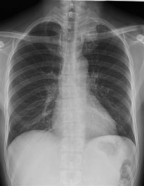 Solid Pleural Lesions Ajr