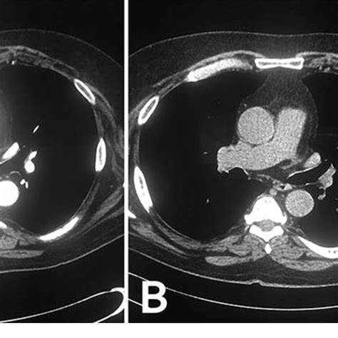 Chest Ct Scans Showed A Hilar Lymph Node Prior To The Ebus Fna A Download Scientific Diagram