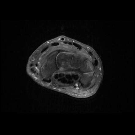 Kienböck disease Image Radiopaedia org