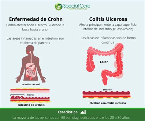 Enfermedad De Crohn Vs Colitis Ulcerosa Chuletas M Dicas Hot Sex Picture