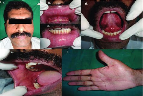 Post-treatment photographs showing complete healing of the ulcers and ...