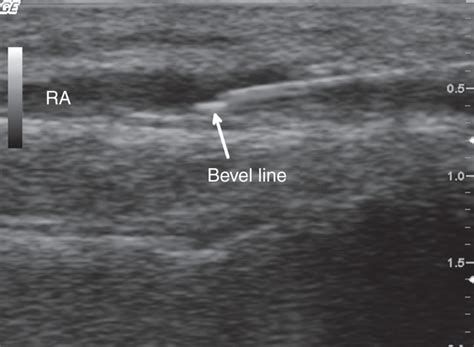 Cannulation Of The Radial Artery In Plane Technique 20 G Arterial Download Scientific Diagram