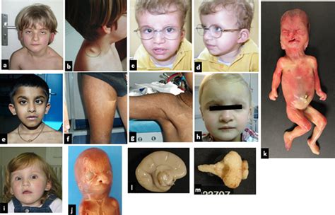 Patients Clinical Features Patient 1 A Facial Appearance Showing In Download Scientific