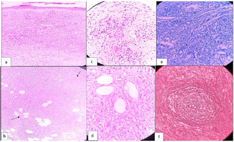 Histopathology Of Deep Seated Nodule From Right Leg A Low Power