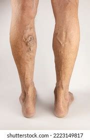 Varicose Veins On Mens Legs Treatment Stock Photo Shutterstock