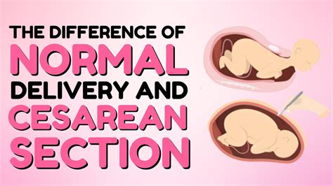 The Difference Of Normal Delivery And Cesarean Section Pagkakaiba Ng