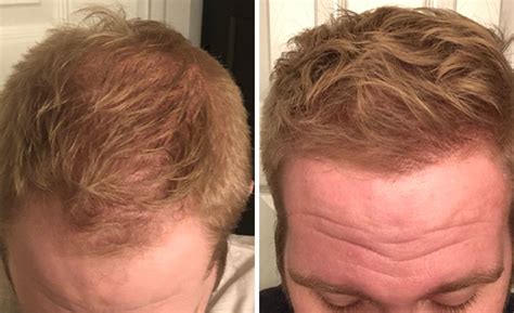 People Who Tried Out Hair Loss Treatments Are Sharing Their Results In This Dedicated Online