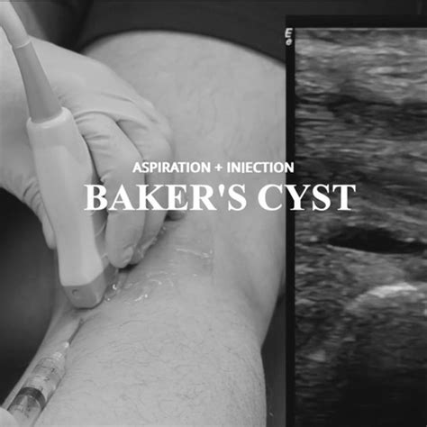 Bakers Cyst Diagnosis & Aspiration | MUST: Msk Ultrasound