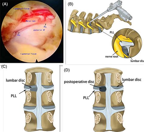 Low Back Pain Induced By Posterior Longitudinal Ligament Incision In