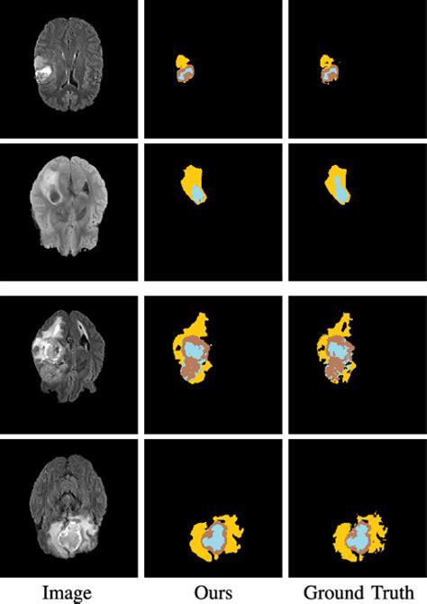 Flexible Fusion Network For Multi Modal Brain Tumor Segmentation