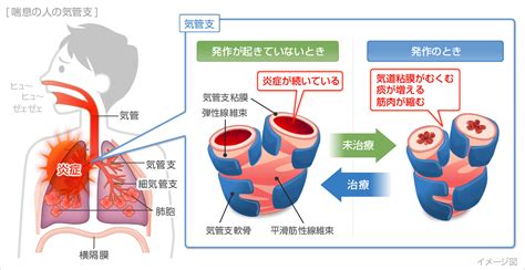 喘息（ぜんそく）の症状・原因｜くすりと健康の情報局