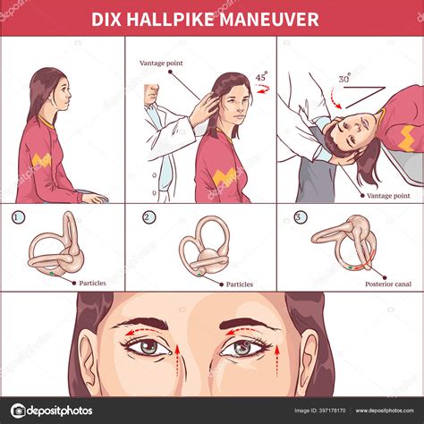 Dix Hallpike Maniobra Vector Ilustraci N Ilustraci N De Stock De