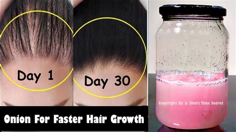 How To Use Onion Juice For Extreme Hair Growth 15 Days Challenge For