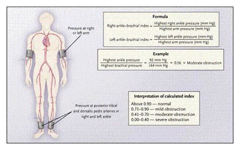 Peripheral Vascular Intervention - Intermittent Claudication